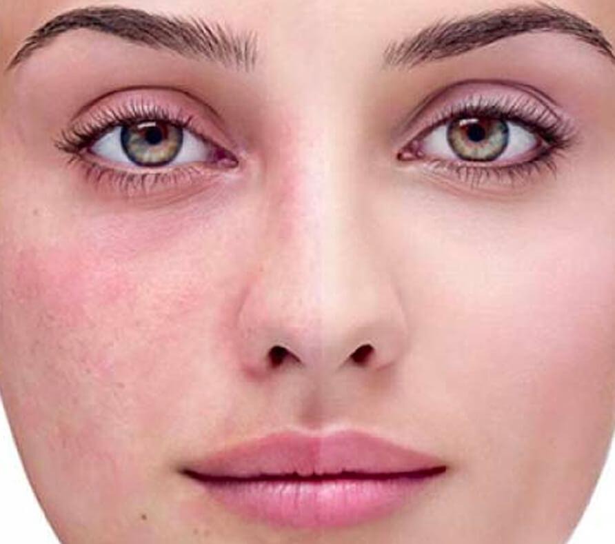 rosacea
